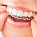 The Benefits of Realigning Your Teeth