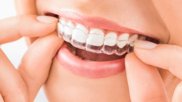 The Benefits of Realigning Your Teeth