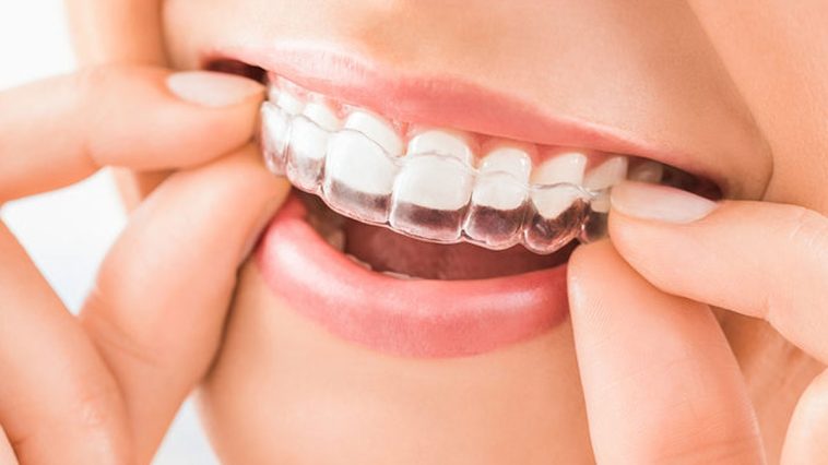 The Benefits of Realigning Your Teeth