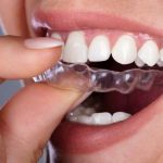 Invisalign Aligner Cutting Your Gums? Here is What You Can Do