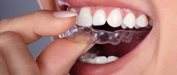Invisalign Aligner Cutting Your Gums? Here is What You Can Do