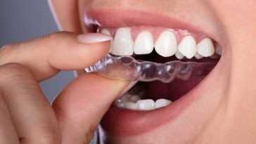 Invisalign Aligner Cutting Your Gums? Here is What You Can Do