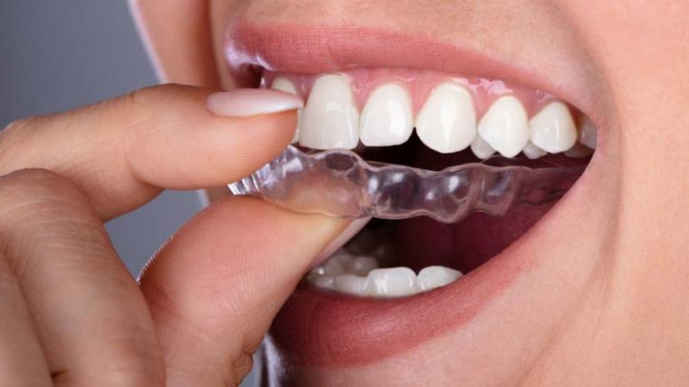 Invisalign Aligner Cutting Your Gums? Here is What You Can Do