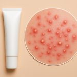 Close-up of pustular acne on skin, highlighting healing and skincare treatment techniques