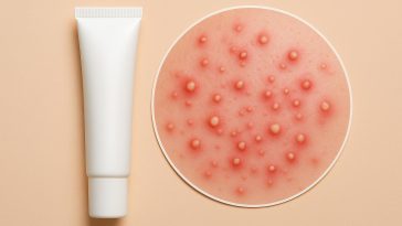 Close-up of pustular acne on skin, highlighting healing and skincare treatment techniques